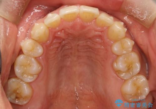 再矯正、後戻りを治したい、マウスピース矯正の治療中