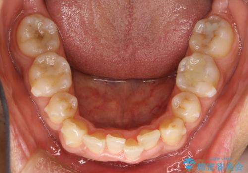 再矯正、後戻りを治したい、マウスピース矯正の治療中