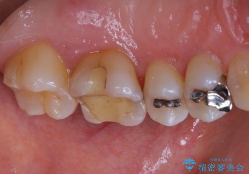 大きな詰め物を被せ物に変えて、歯の破折リスクを減らすの症例 治療前