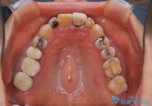 大きな詰め物を被せ物に変えて、歯の破折リスクを減らすの治療前