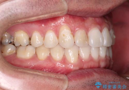 【モニター】 インビザライン・ライトによる軽微叢生の矯正治療の治療中