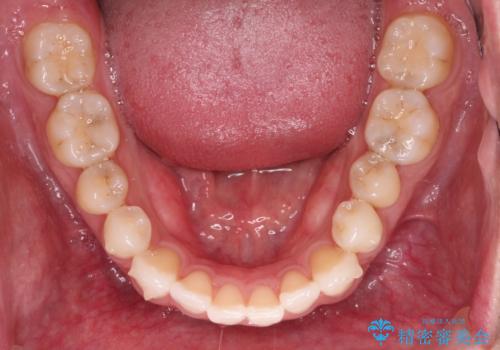 【モニター】 インビザライン・ライトによる軽微叢生の矯正治療の治療中