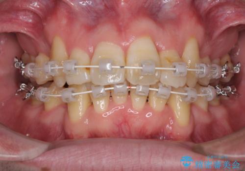 ものが挟まる　著しい叢生を解消　ワイヤー装置による抜歯矯正の治療中