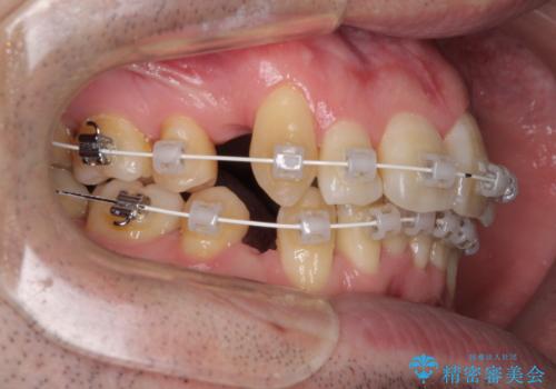 ものが挟まる 著しい叢生を解消 ワイヤー装置による抜歯矯正の治療中