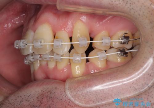 ものが挟まる 著しい叢生を解消 ワイヤー装置による抜歯矯正の治療中