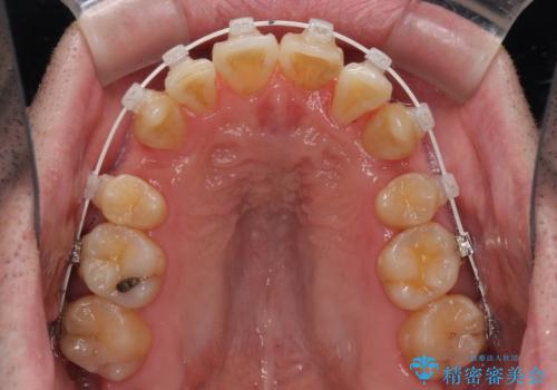 ものが挟まる　著しい叢生を解消　ワイヤー装置による抜歯矯正の治療中