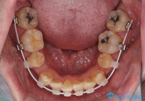 ものが挟まる 著しい叢生を解消 ワイヤー装置による抜歯矯正の治療中