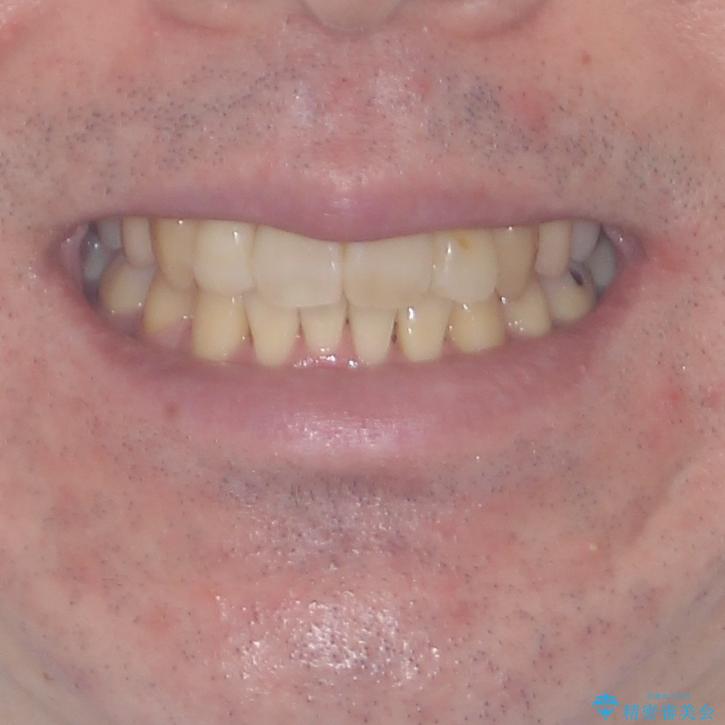 ものが挟まる 著しい叢生を解消 ワイヤー装置による抜歯矯正の治療後(顔貌)