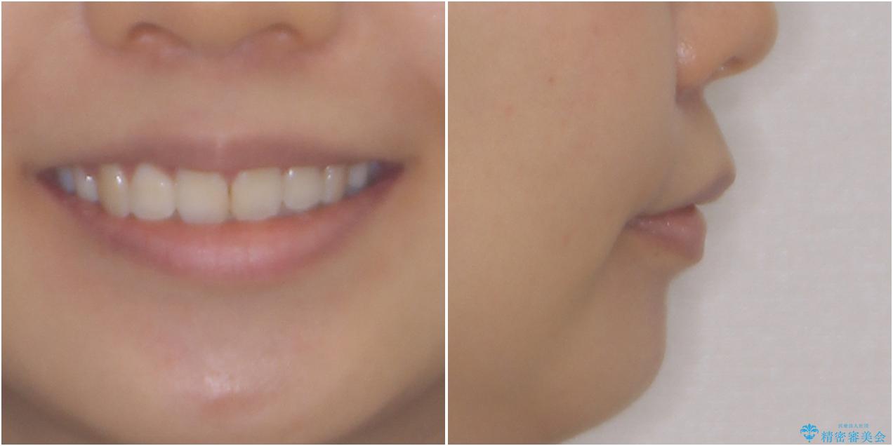 口元の突出感を改善 2年弱での抜歯矯正の治療後(顔貌)