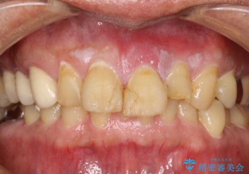 折れた前歯を使えるように、抜かないで残す方法の症例 治療前