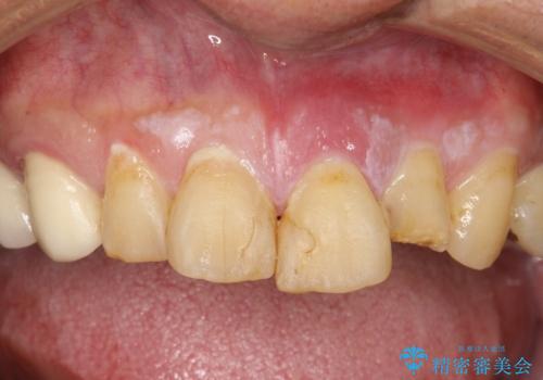 折れた前歯を使えるように、抜かないで残す方法の治療前