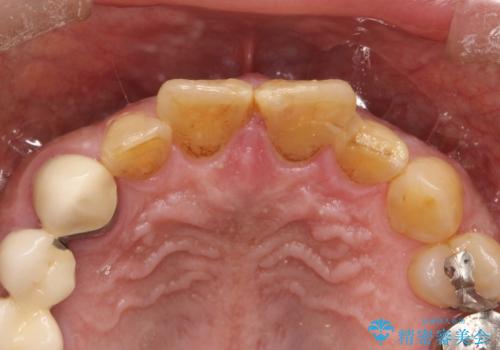 折れた前歯を使えるように、抜かないで残す方法の治療前