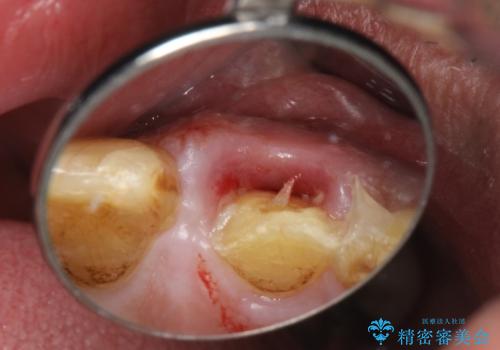 折れた前歯を使えるように、抜かないで残す方法の治療前