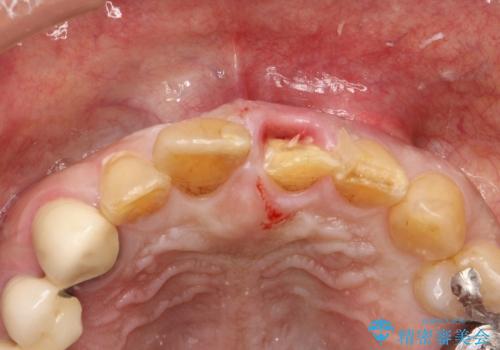 折れた前歯を使えるように、抜かないで残す方法の治療中