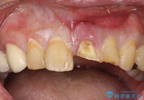 折れた前歯を使えるように、抜かないで残す方法