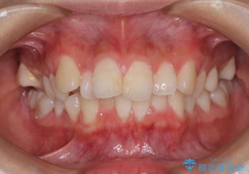 口元の突出感を改善　2年弱での抜歯矯正の症例 治療前