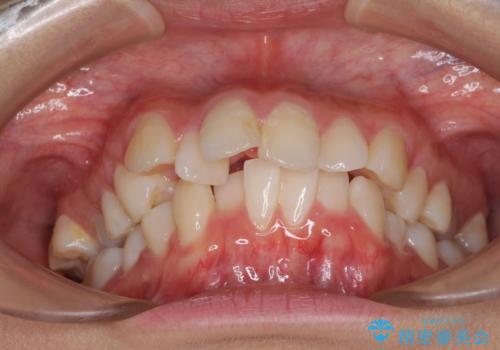 口元の突出感を改善 2年弱での抜歯矯正の治療前