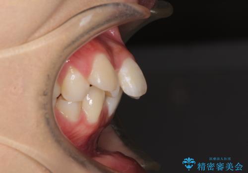口元の突出感を改善 2年弱での抜歯矯正の治療前