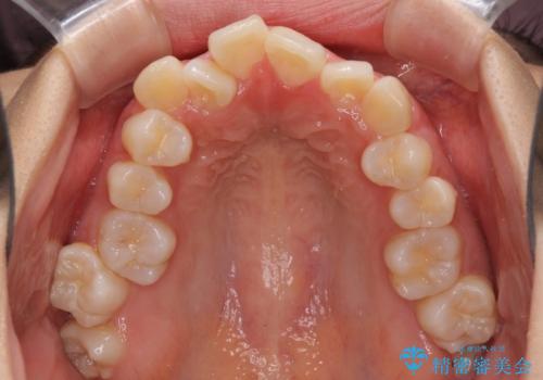 口元の突出感を改善 2年弱での抜歯矯正の治療前