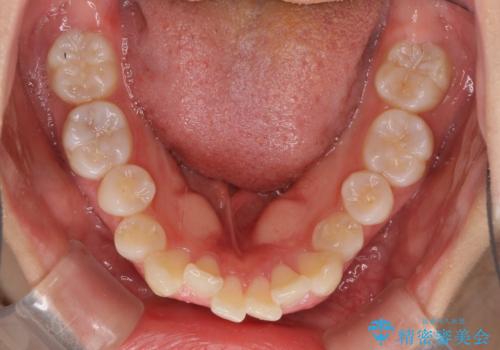 口元の突出感を改善 2年弱での抜歯矯正の治療前