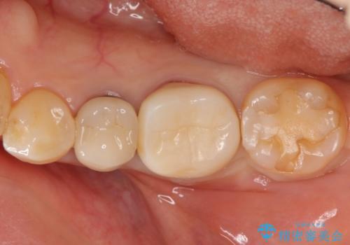 [ 歯牙破折 ]  違和感のある大臼歯 ブリッジ治療の症例 治療前