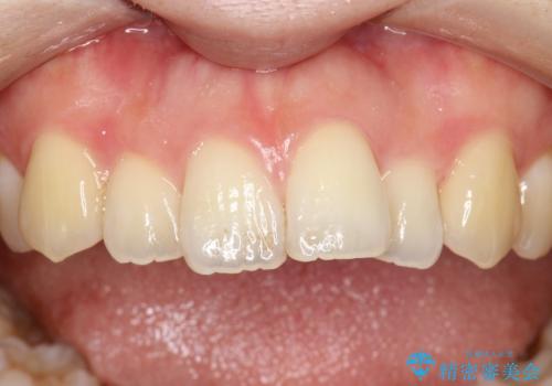 茶渋による汚れをクリーニングできれいにの治療前