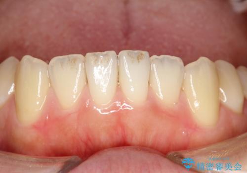 茶渋による汚れをクリーニングできれいにの治療前