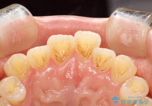 茶渋による汚れをクリーニングできれいにの治療前