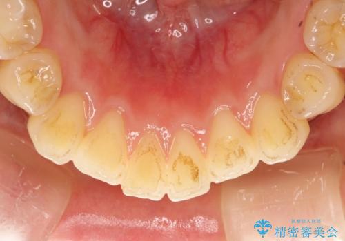茶渋による汚れをクリーニングできれいにの治療前