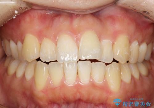 茶渋による汚れをクリーニングできれいにの症例 治療後