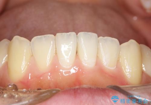 茶渋による汚れをクリーニングできれいにの治療後