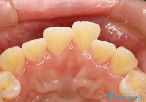 茶渋による汚れをクリーニングできれいにの治療後