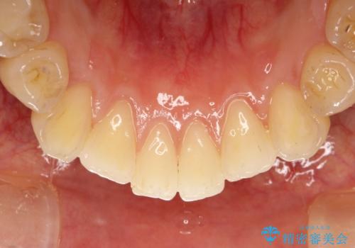 茶渋による汚れをクリーニングできれいにの治療後