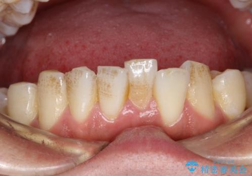 タバコのヤニを取って歯を白くしたいの治療前