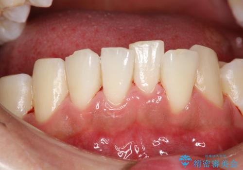 タバコのヤニを取って歯を白くしたいの治療後