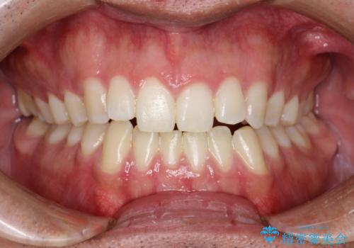 PMTC30分コースで前歯のみクリーニングの治療前