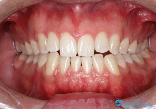 PMTC30分コースで前歯のみクリーニングの治療後