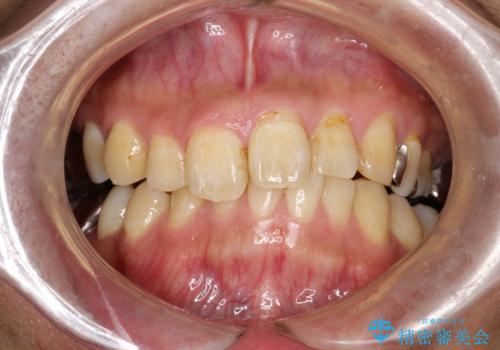 PMTCで歯の着色落としの症例 治療前