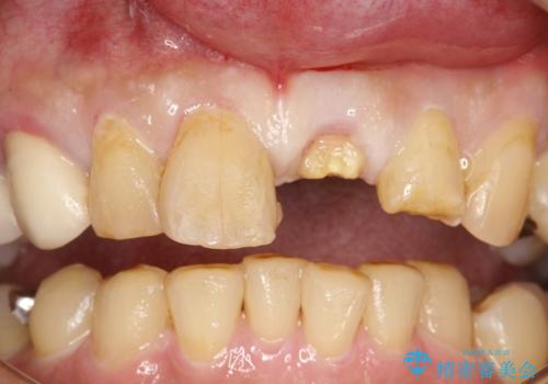 折れた前歯を使えるように、抜かないで残す方法の治療前