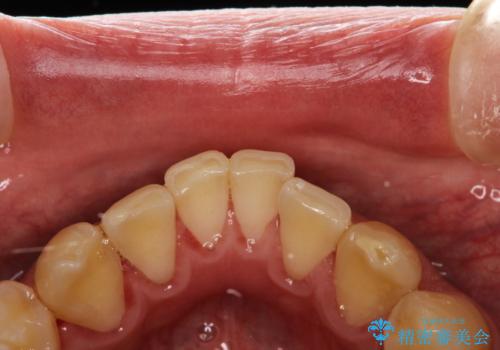 PMTCで歯の着色落としの治療後