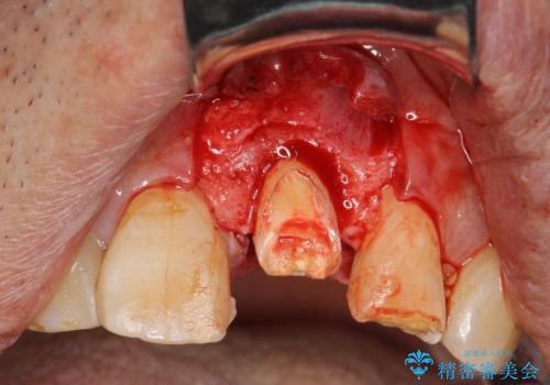 折れた前歯を使えるように、抜かないで残す方法の治療中