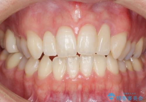 歯の外部吸収 難しい根の治療 30代男性の治療後