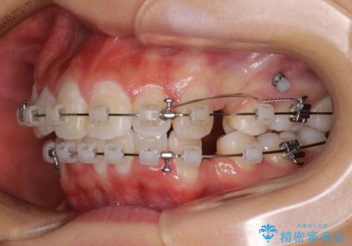 口元の突出感を改善 2年弱での抜歯矯正の治療中