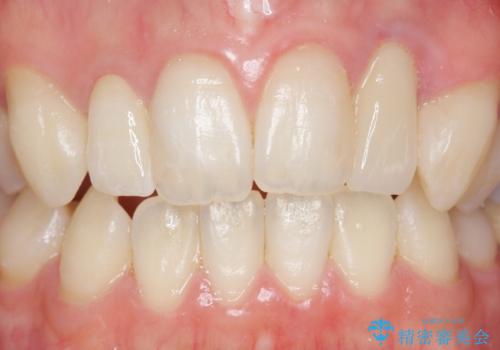 歯の外部吸収 難しい根の治療 30代男性の治療後