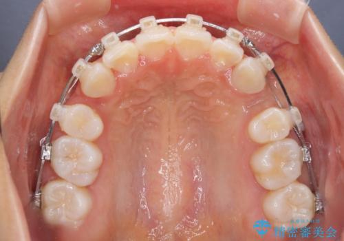 口元の突出感を改善 2年弱での抜歯矯正の治療中