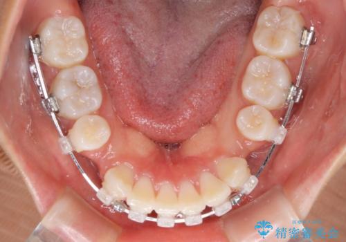 口元の突出感を改善 2年弱での抜歯矯正の治療中