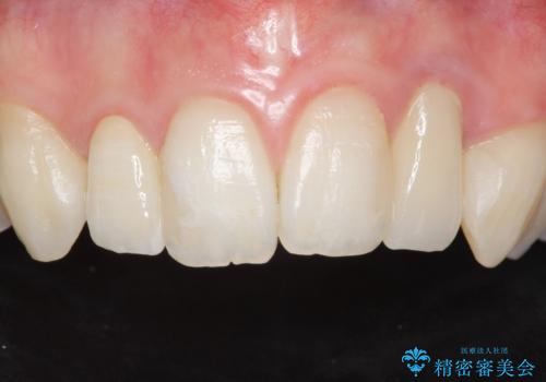 歯の外部吸収 難しい根の治療 30代男性の治療後