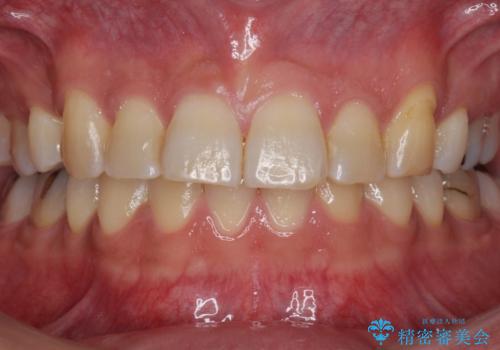 前歯だけ治したい インビザライン・ライト 30代男性の症例 治療前