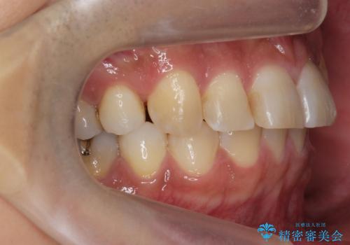 前歯だけ治したい インビザライン・ライト 30代男性の治療前