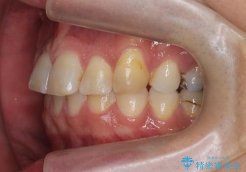 前歯だけ治したい インビザライン・ライト 30代男性の治療前